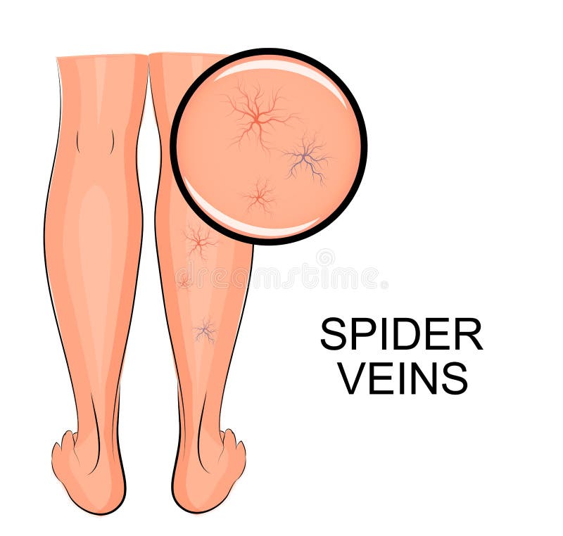 Venas de la araña en las piernas ilustración del vector Venas de la araña en las piernas ilustración del vector
