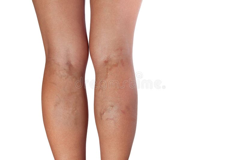 Vene varicose delle gambe della donna