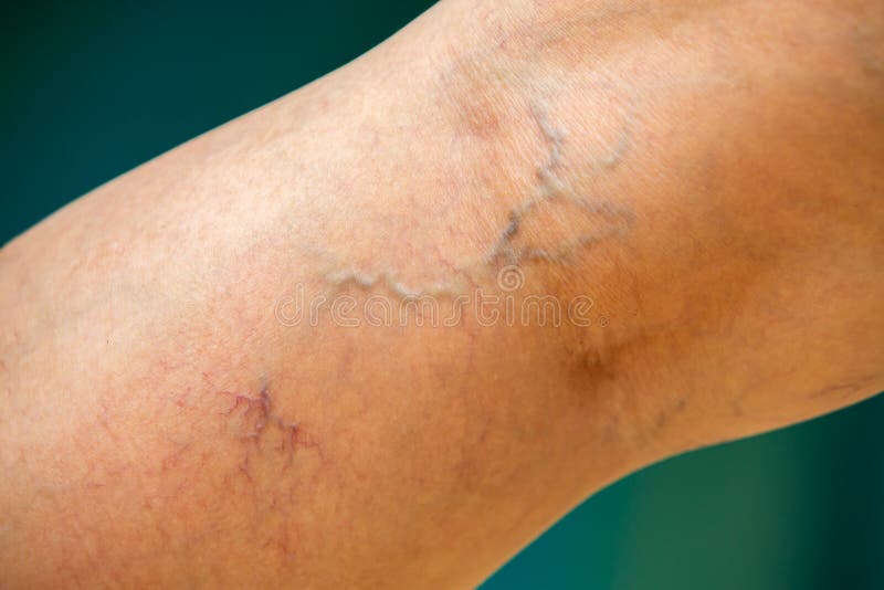 Vene varicose sul dorso del ginocchio e della gamba nella piscina blu di una donna sfondo di nuoto sfondo di pelle asiatica parte