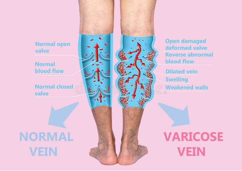 Vene varicose sull'gambe senior femminili La struttura delle vene normali e varicose