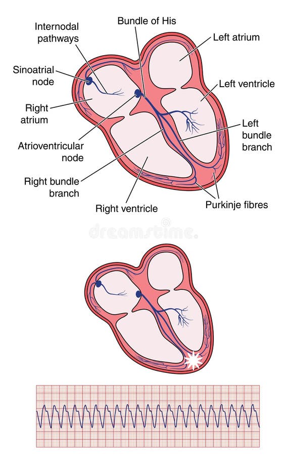 Ventricular Tachycardia Of Heart Stock Vector ...