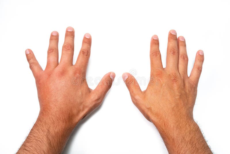 Vergleich von zwei männlichen Händen gestochen durch Biene oder Wespe Handschwellen, Entzündung, Rötung sind- Zeichen der Infekti