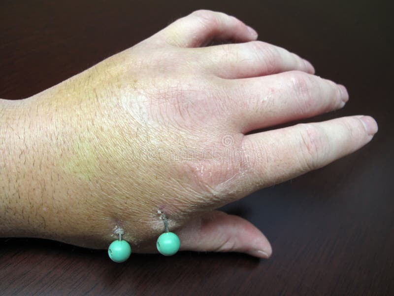 Verletzte Hand mit chirurgischen Stiften stockbilder Verletzte Hand mit chirurgischen Stiften stockbilder