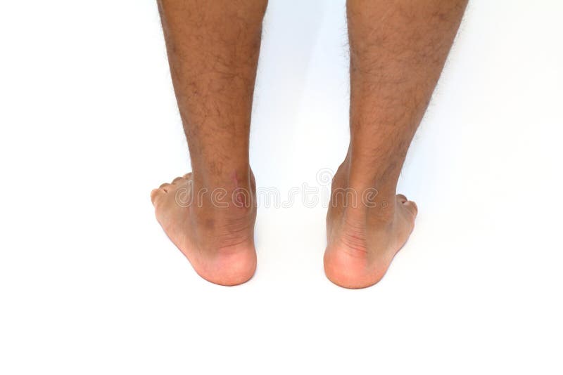 Verrichtingslitteken van Achilles peesbreuk royalty-vrije stock fotografie Verrichtingslitteken van Achilles peesbreuk royalty-vrije stock fotografie