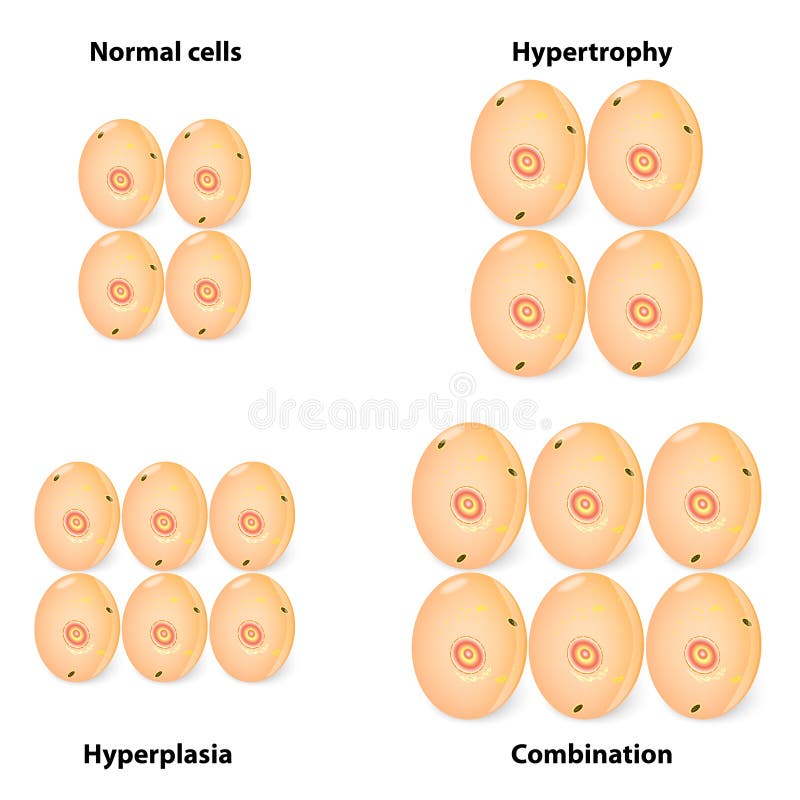 Verschilhyperplasia, hypertrofie en normale cel stock illustratie Verschilhyperplasia, hypertrofie en normale cel stock illustratie