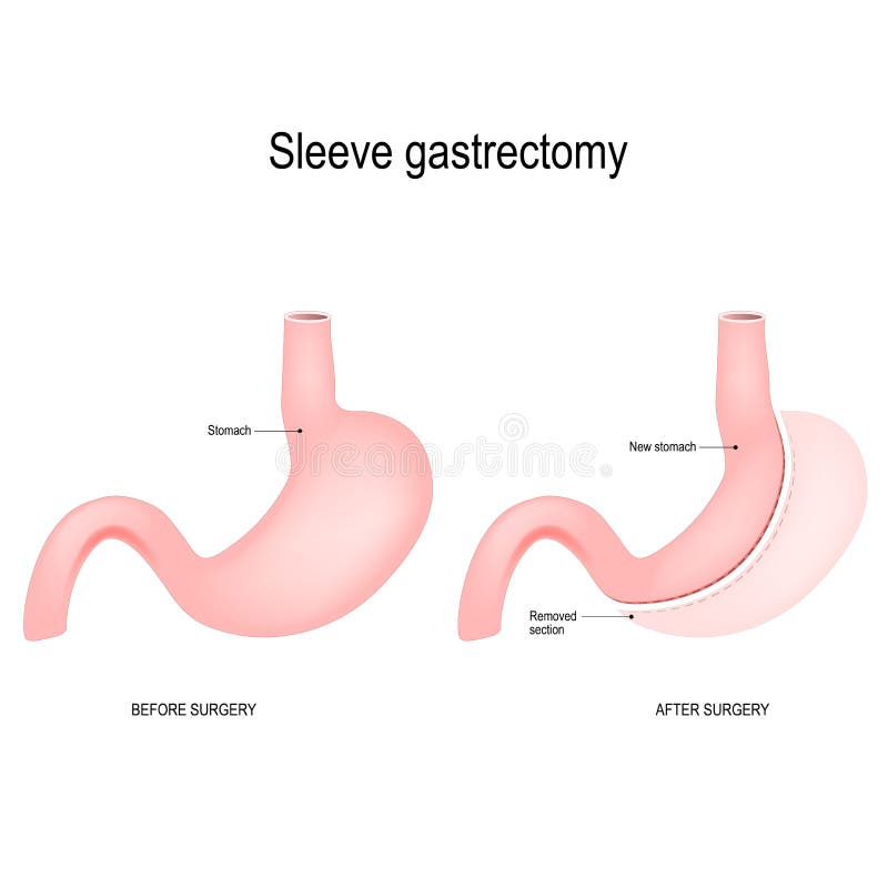 Vertical sleeve gastrectomy royalty free illustration Vertical sleeve gastrectomy royalty free illustration