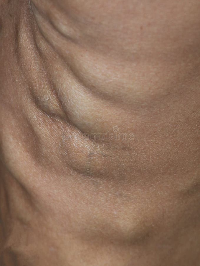 Close up of varicaose veins stock photo Close up of varicaose veins stock photo
