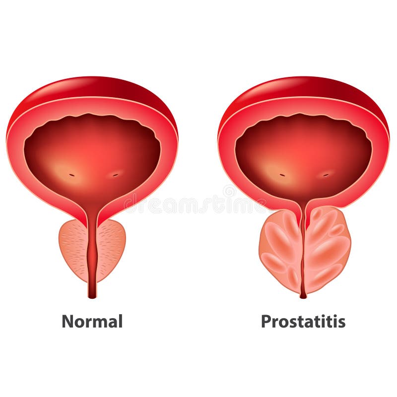  Vetor isolado próstata normal e inflamado da prostatite ilustração royalty free