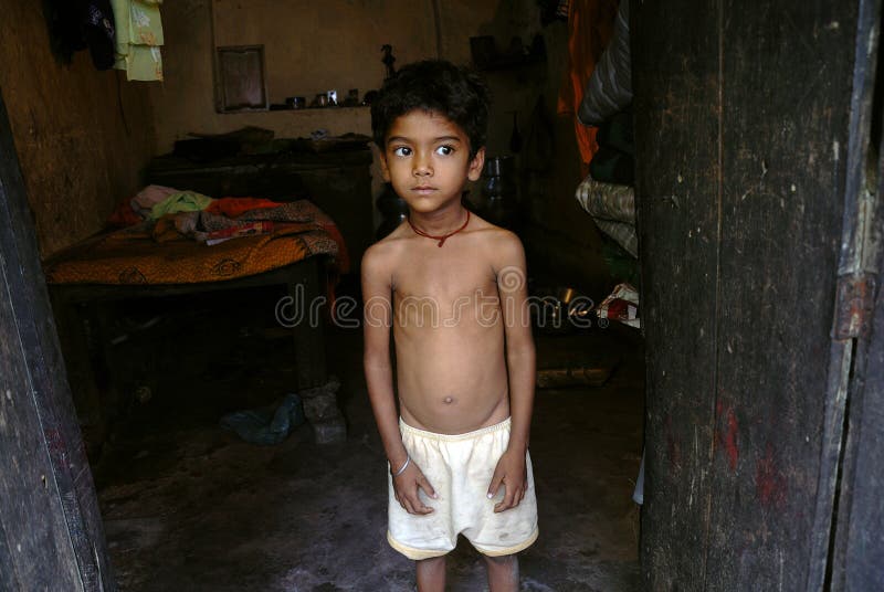 TINKU age 6 years suffering from heart disease,living in a slum area of Jharia. TINKU age 6 years suffering from heart disease,living in a slum area of Jharia.