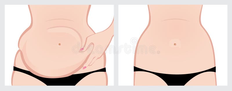 Fat belly before and after treatment. Vector image on a white background. Scroll down to see more of my designs linked below. Fat belly before and after treatment. Vector image on a white background. Scroll down to see more of my designs linked below.