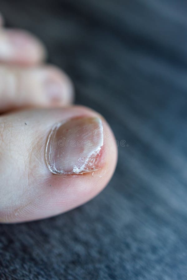 View of Partial Detachment of the Toenail from the Nail Bed Due To ...