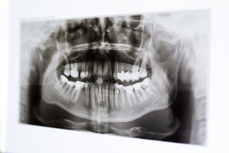 Xrays of the Jaw and Teeth Stock Photo Image of ultrasound, medicine 89216966