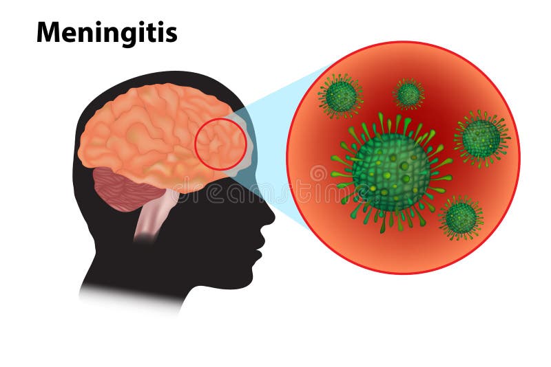 Viral meningitis and encephalitis vector illustration Viral meningitis and encephalitis vector illustration