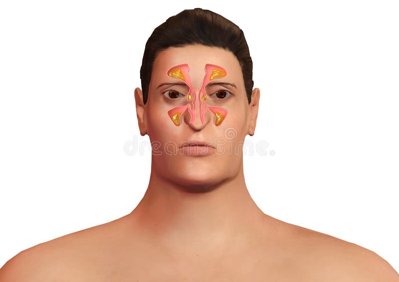 Visage de l'homme avec les sinus nasaux enflammés avec la sinusite Malaise allergique de sinusite et de corps illustration libre de droits Visage de l'homme avec les sinus nasaux enflammés avec la sinusite Malaise allergique de sinusite et de corps illustration libre de droits