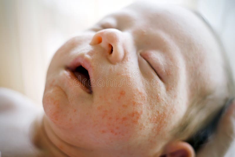 Les Boutons Provoques Par Le Moustique Ou Les Drains Volent Sur Le Bras D Un Enfant Photo Stock Image Du Endroits Disease Les Boutons Provoques Par Le Moustique Ou Les Drains Volent Sur Le Bras D Un Enfant Photo Stock Image Du Endroits Disease