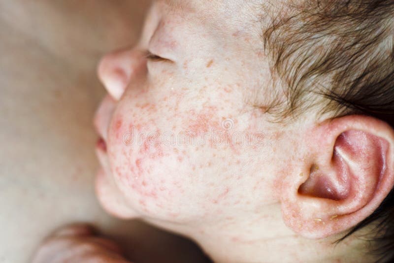 Les Boutons Provoques Par Le Moustique Ou Les Drains Volent Sur Le Bras D Un Enfant Photo Stock Image Du Endroits Disease Les Boutons Provoques Par Le Moustique Ou Les Drains Volent Sur Le Bras D Un Enfant Photo Stock Image Du Endroits Disease