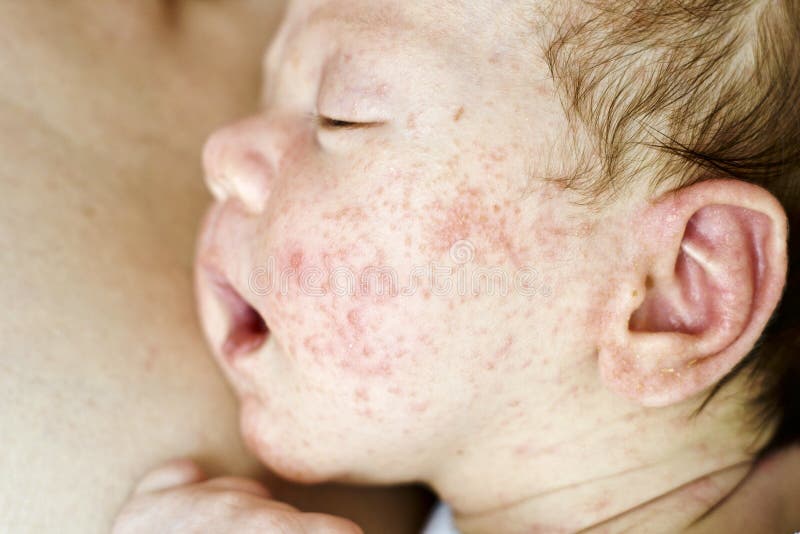 Les Boutons Provoques Par Le Moustique Ou Les Drains Volent Sur Le Bras D Un Enfant Photo Stock Image Du Endroits Disease Les Boutons Provoques Par Le Moustique Ou Les Drains Volent Sur Le Bras D Un Enfant Photo Stock Image Du Endroits Disease