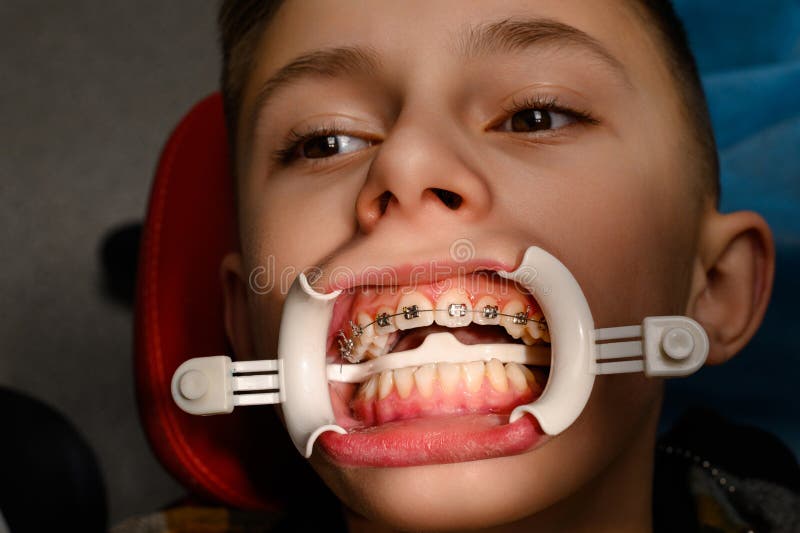 Visit To the Orthodontist, Installation of Braces on the Upper Teeth