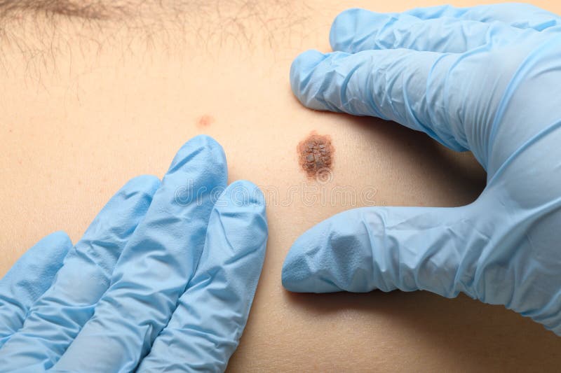 Visual examination of the mole for the presence of malignant neoplasms. Prevention for detecting skin cancer and melanoma