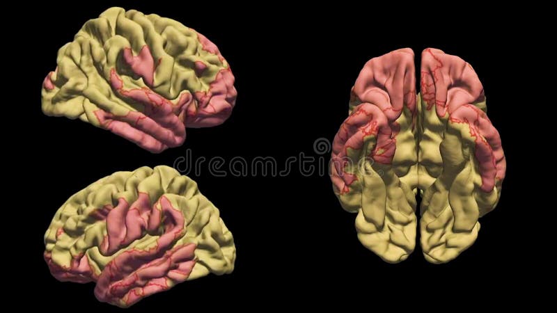 Visualisering av delar av hjärnan var för sig. röd glöd.