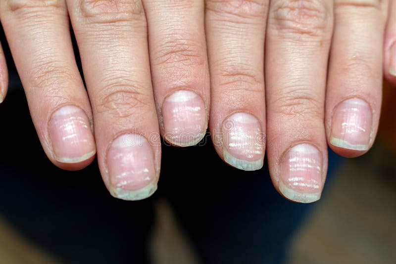 2. Nail Bed Color Changes in Anemia - wide 2