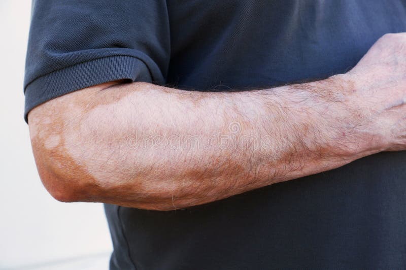 Vitiligo photo stock Vitiligo photo stock