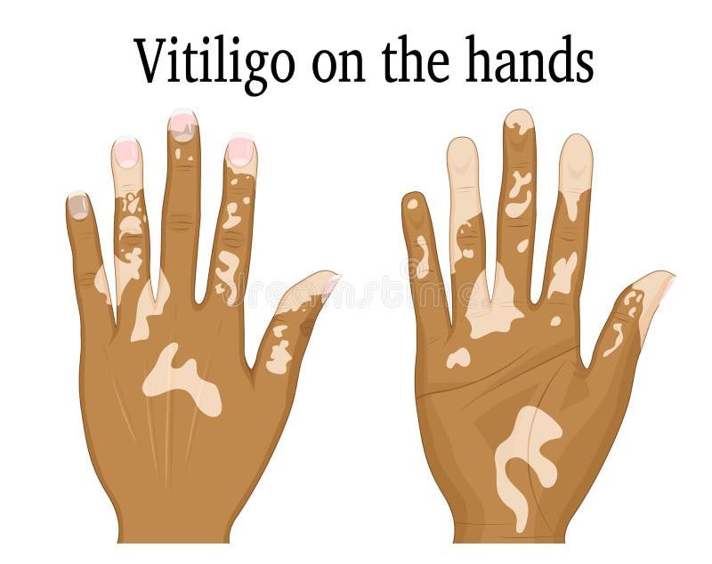 Vitiligo on the hands stock vector. Illustration of dermatology 78113502