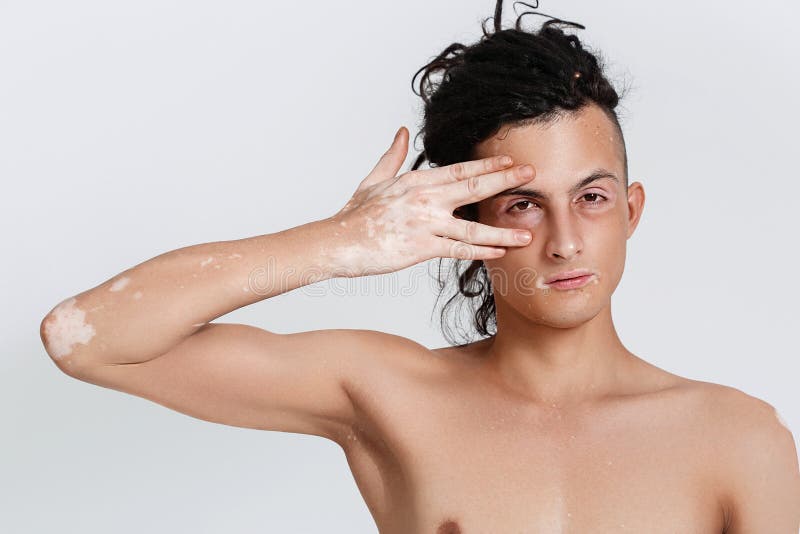 Vitiligo Male Model Stock Photos Free & RoyaltyFree Stock Photos