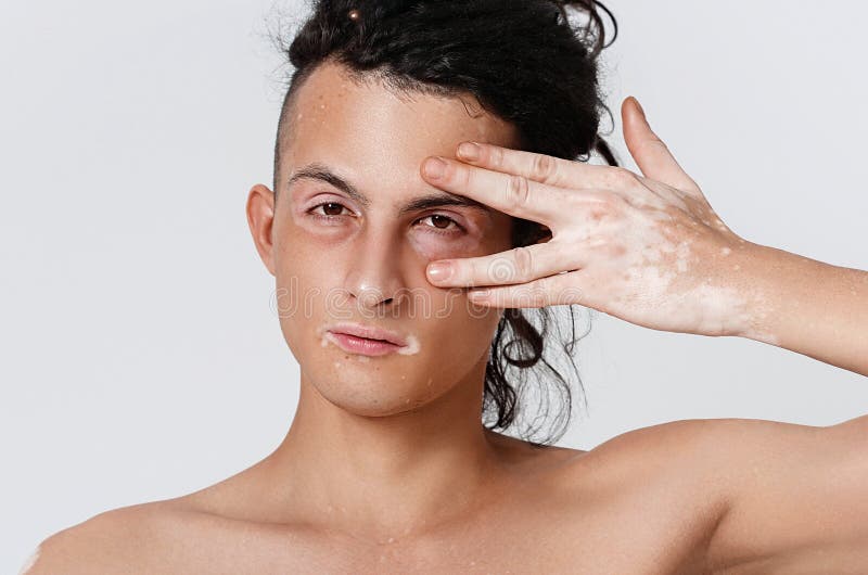 Vitiligo Male Model Stock Photos Free & RoyaltyFree Stock Photos