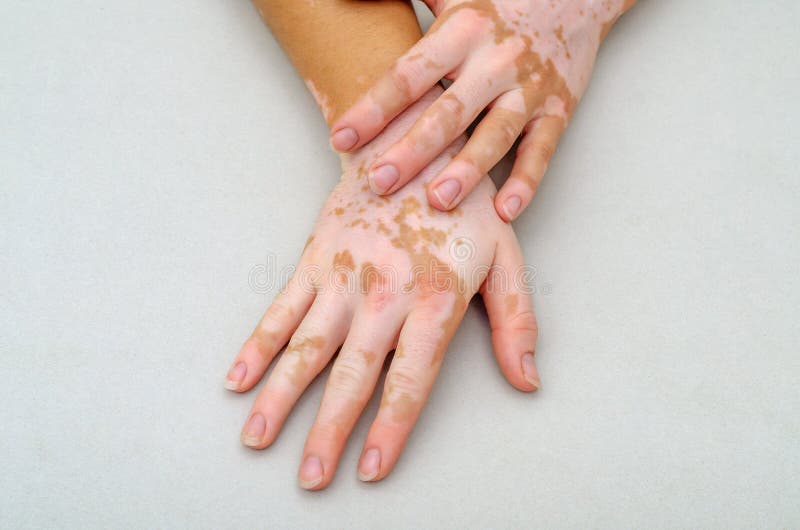 Vitiligo on the Skin of Hands Stock Photo Image of back, care 155933700