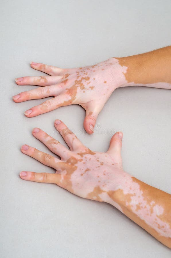 Vitiligo on the Skin of Hands Stock Photo Image of close, medicine