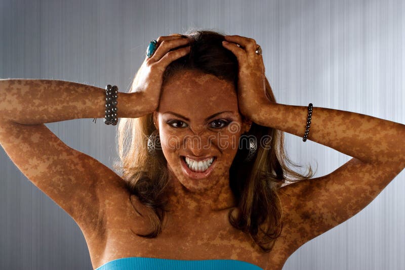 vitiligo кожи условия стоковые фотографии rf vitiligo кожи условия стоковые фотографии rf