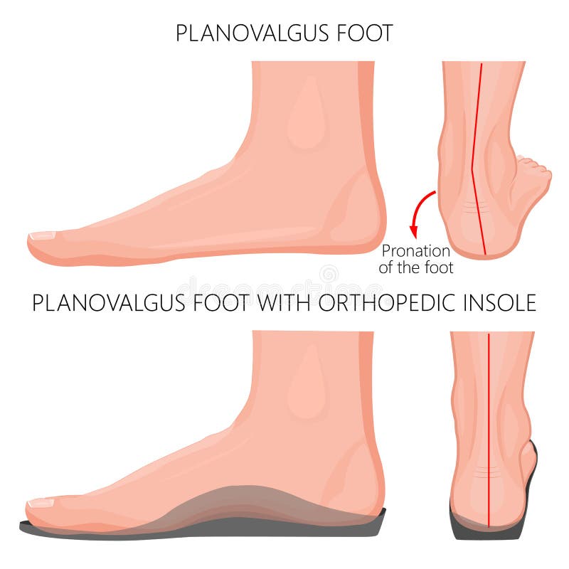 Vlakke voet met orthopedische insole_Exretnal wiew vector illustratie Vlakke voet met orthopedische insole_Exretnal wiew vector illustratie
