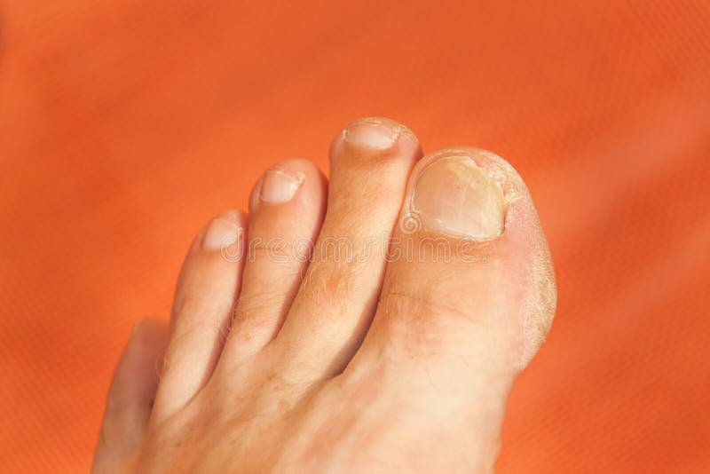 Vliegen op uw vingers Sluit omhoog geschoten van een slechte spijkervinger Nagelverzorging op de voet - pedicure royalty-vrije stock fotografie Vliegen op uw vingers Sluit omhoog geschoten van een slechte spijkervinger Nagelverzorging op de voet - pedicure royalty-vrije stock fotografie