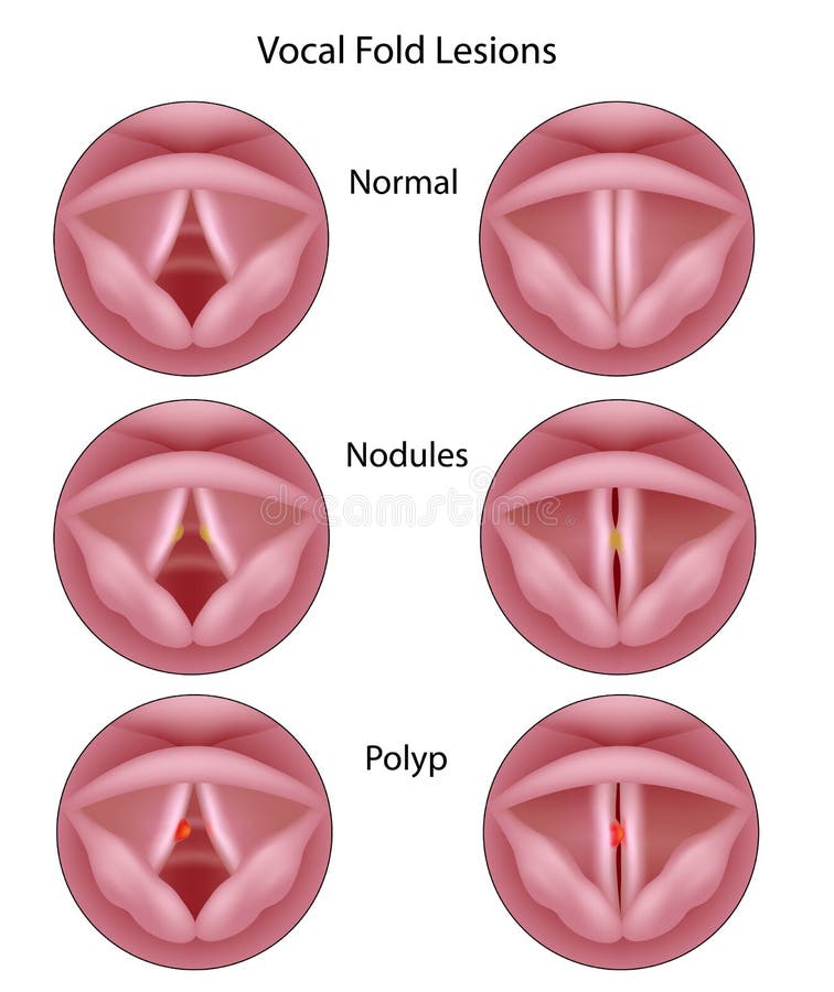 Vocal cord lesions