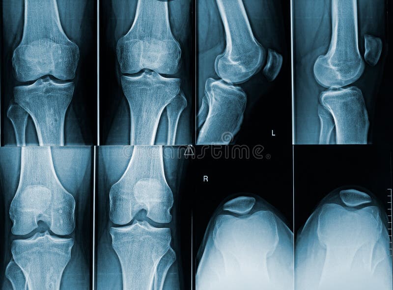 Adult male knees x-ray image with different angles. Medical and human anatomy imagery. Adult male knees x-ray image with different angles. Medical and human anatomy imagery