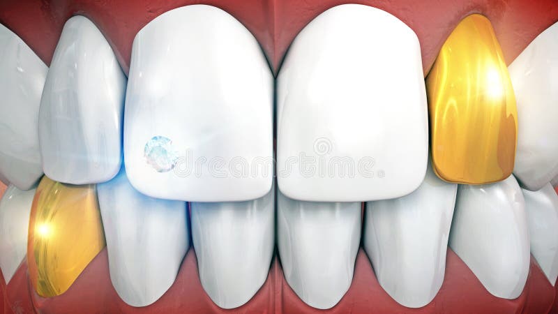 Voorafgaande tanden met halfedelsteenimplant en eyeteeth in goud vector illustratie Voorafgaande tanden met halfedelsteenimplant en eyeteeth in goud vector illustratie