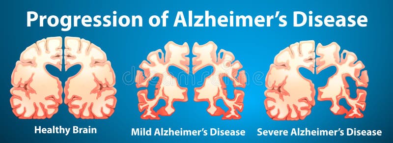 Vooruitgang van de ziekte van Alzheimer op blauwe achtergrond stock illustratie Vooruitgang van de ziekte van Alzheimer op blauwe achtergrond stock illustratie