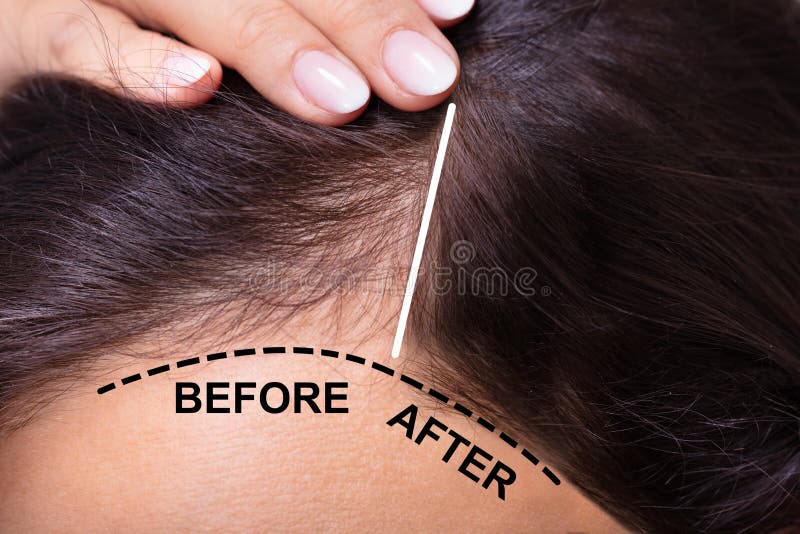 Vor und nach der Haarausfallbehandlung