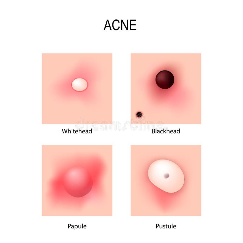 Vulgar de acne Fases do desenvolvimento Tipos de espinhas ilustração do vetor Vulgar de acne Fases do desenvolvimento Tipos de espinhas ilustração do vetor