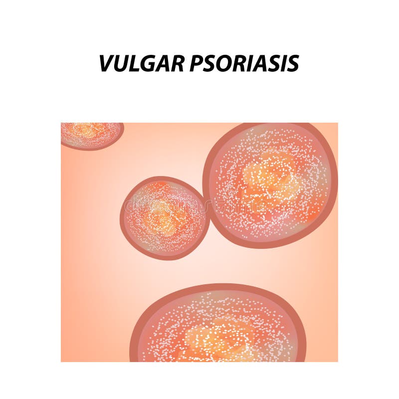 Diabetes 7 Berraschende Symptome Focus Online Diabetes 7 Berraschende Symptome Focus Online