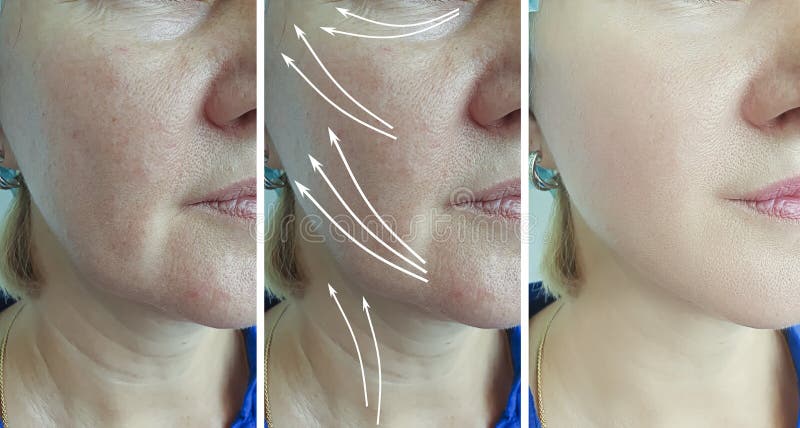 Woman face wrinkles before and after treatment collage arrow thread lifting procedure. Woman face wrinkles before and after treatment collage arrow thread lifting procedure