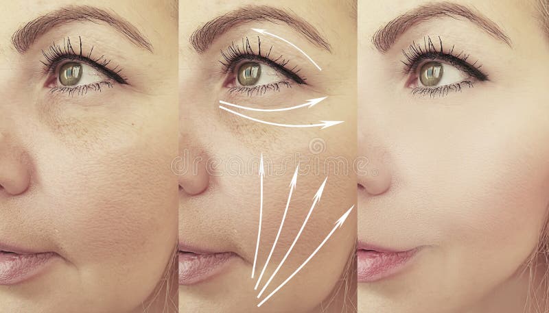 Woman face wrinkles before and after treatment thread lifting  result lifting effect. Woman face wrinkles before and after treatment thread lifting  result lifting effect