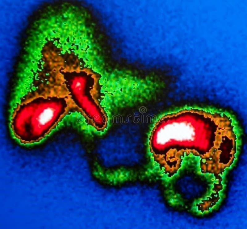 Red tracer filling gallbladder and upper part of intestine no tracer in ducts of liver and gallbladder its delay test for revealing real pathology or ejection fraction of gallbladder, background is blue, liver and intestine are green. Red tracer filling gallbladder and upper part of intestine no tracer in ducts of liver and gallbladder its delay test for revealing real pathology or ejection fraction of gallbladder, background is blue, liver and intestine are green