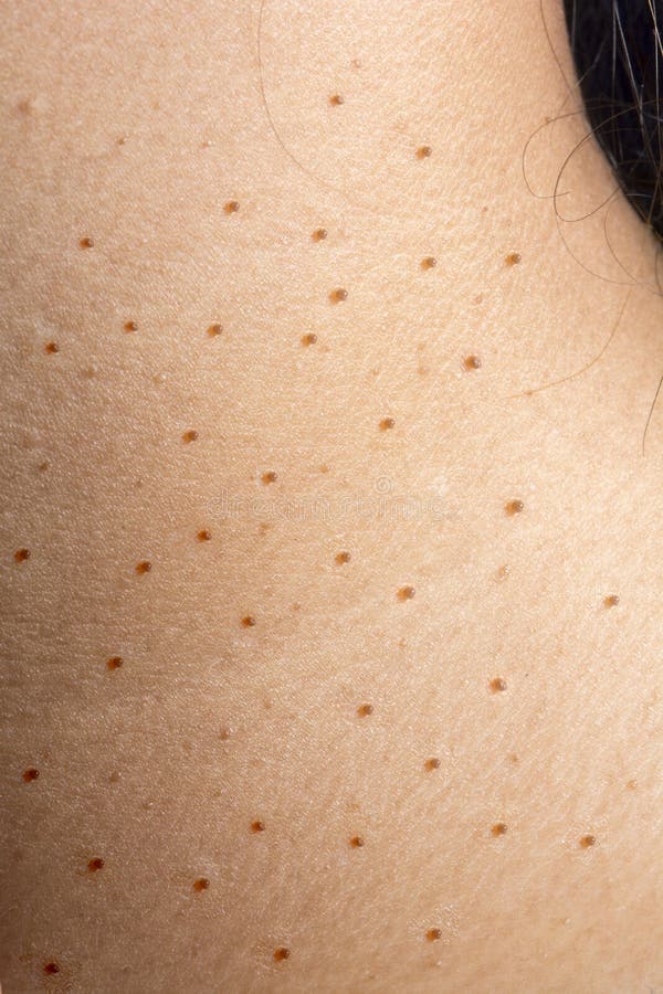 Wart or Dermatitis on Neck Skin Stock Image Image of wart, senior