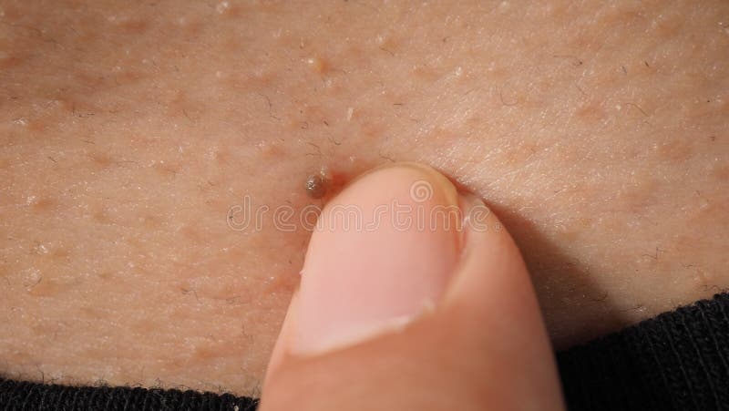 Wart on Face. Macro Shot of Wart Near Eye Stock Photo - Image of melanoma,  benign: 236546840