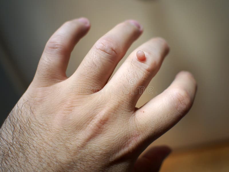 warts on hands medical term