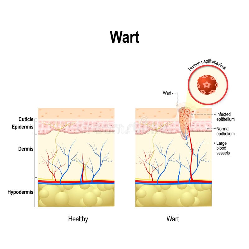 hpv wart cancer