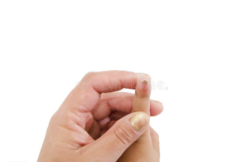 papilloma finger