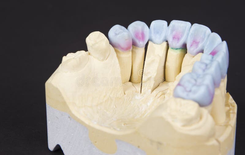 Wax denture stock photo. Image of teeth, prosthesis, bridge 29102292